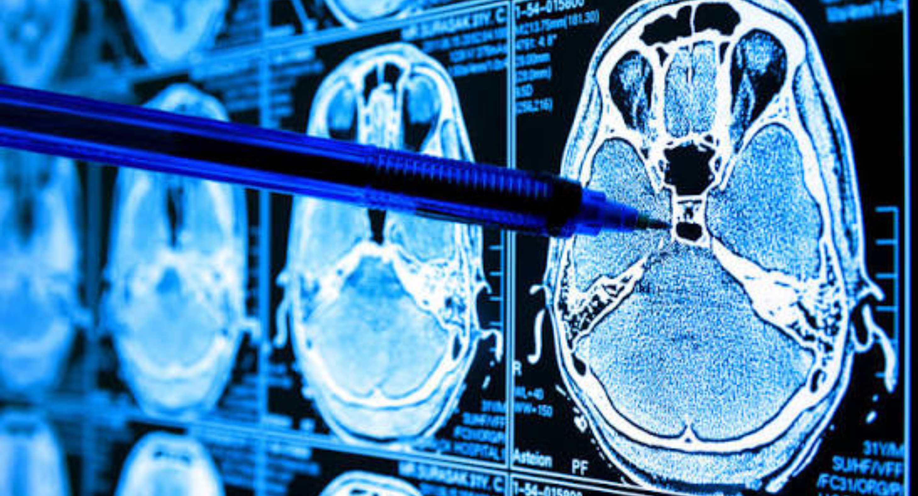 Ai cancer imaging benefits safety — cancer awareness article by Dr. Nishith Vaddeboina, Medical Oncologist in Hyderabad