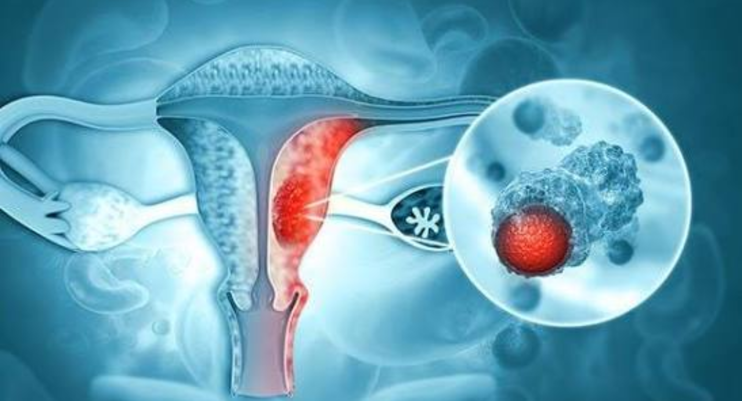 Gynecological Cancers — cancer awareness article by Dr. Nishith Vaddeboina, Medical Oncologist in Hyderabad
